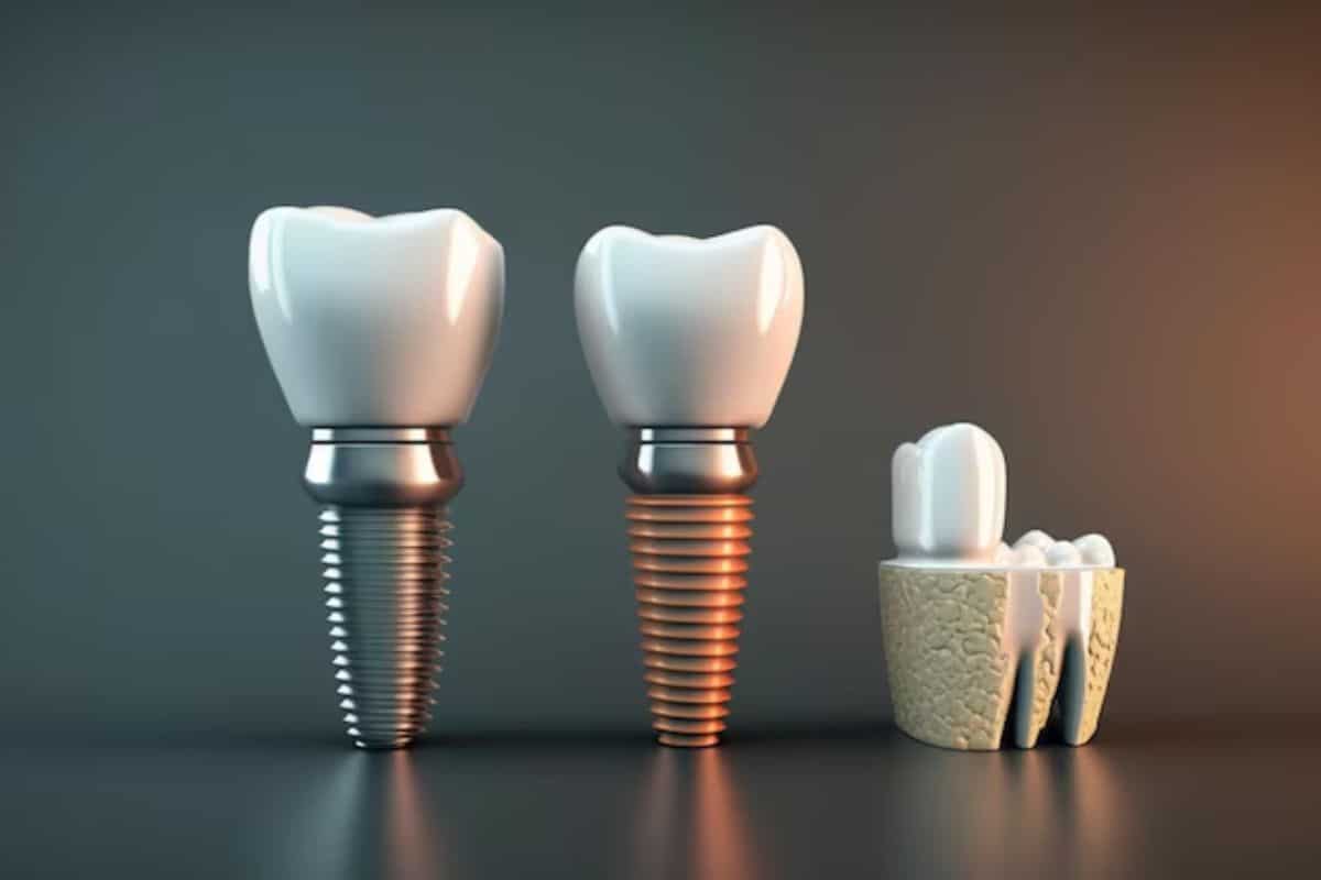 Dental Implants Lafayette