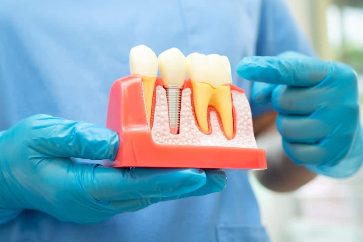 Dental Implants Lafayette