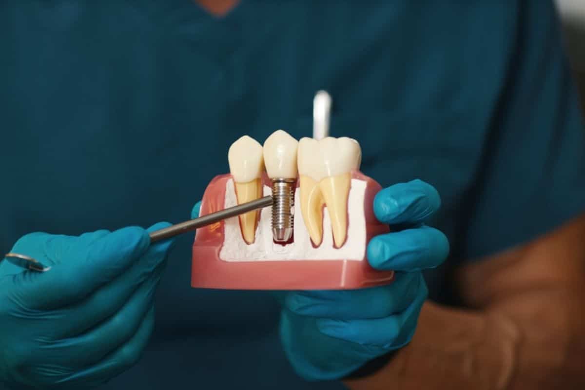 How to Prevent Infection After Implant Dentistry