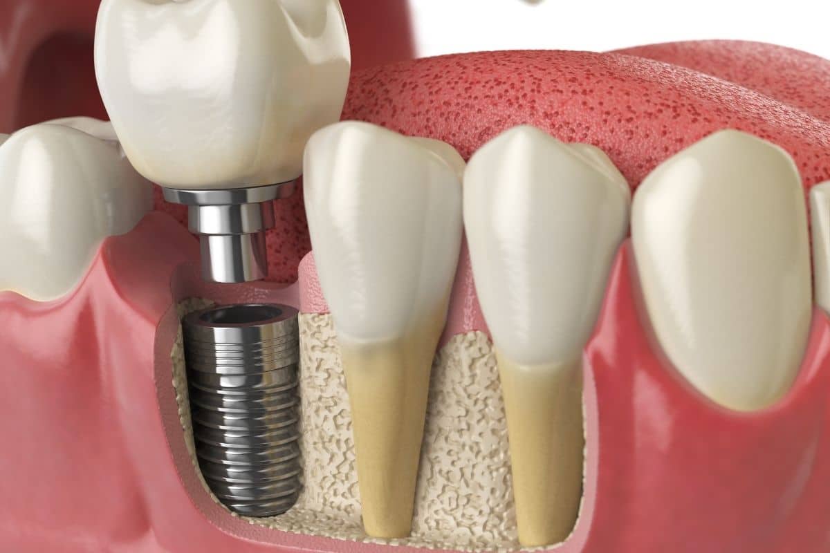 dentist in lafayette
