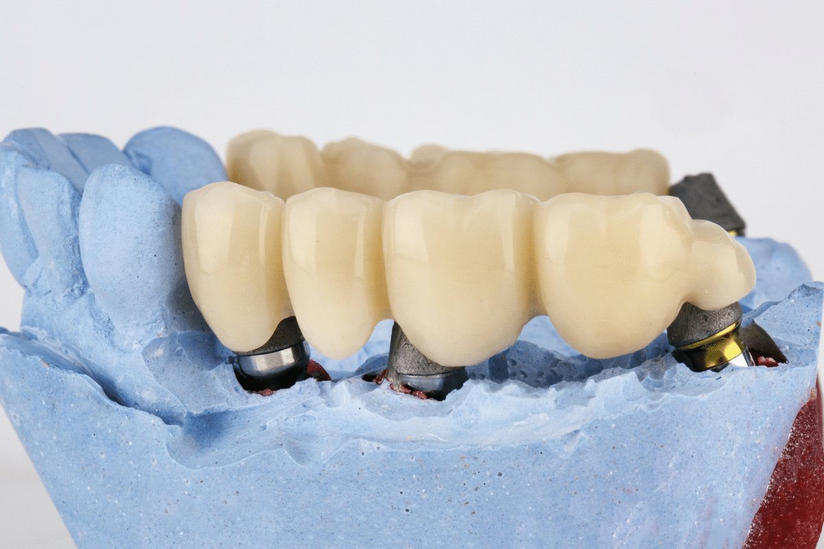 Are Dental Bridges Painful? Let’s Clear the Fear